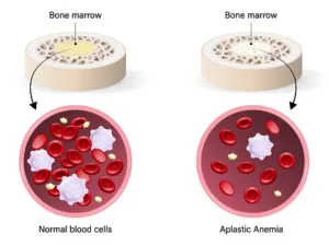 Aplastic Anemia