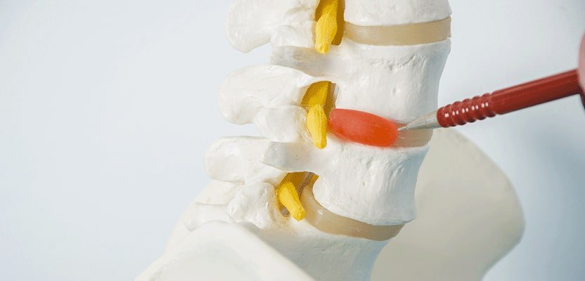 How-to-Treat-Herniated-Disc