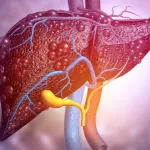 Liver Cancer