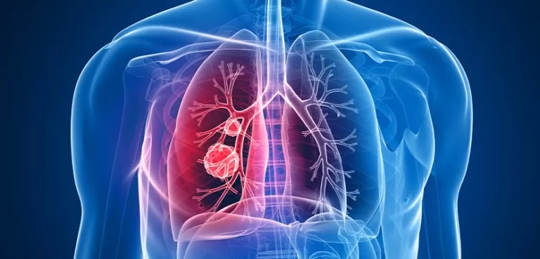 Lung-Cancer