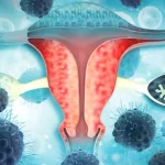 Ovarian Cancer