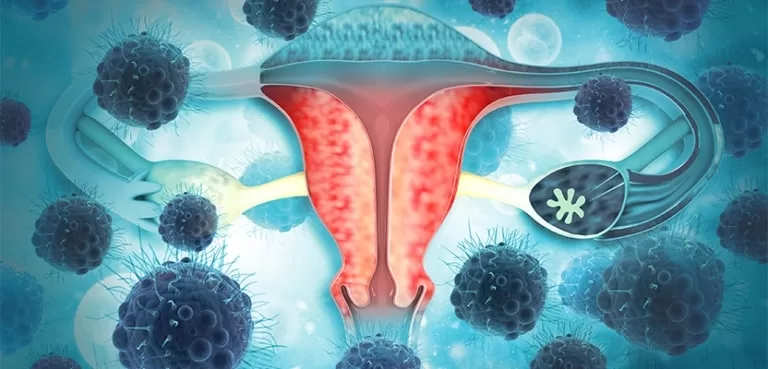 Ovarian-Cancer