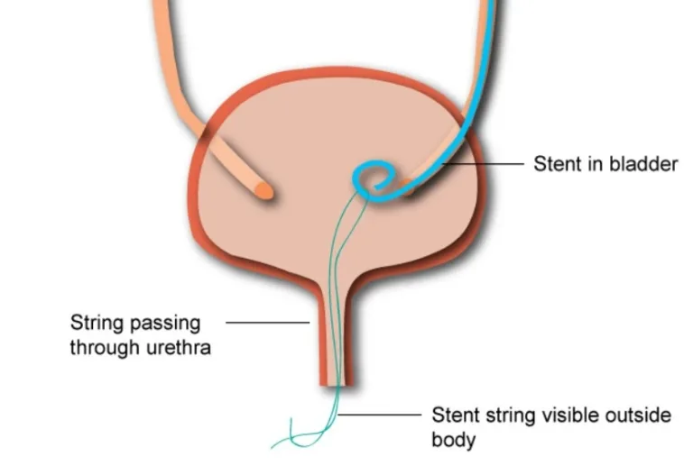 Ureteral Stent