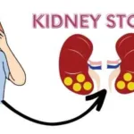 What Cause kidney stones