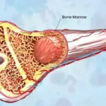 bone marrow transplant