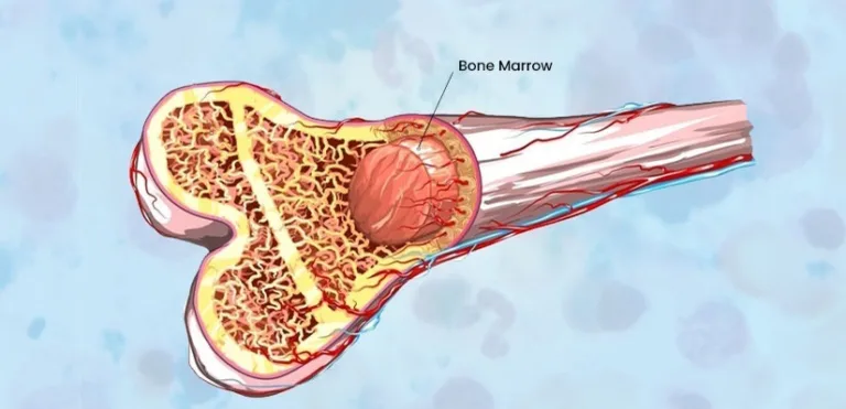 bone marrow transplant