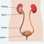 how to sleep with kidney stent