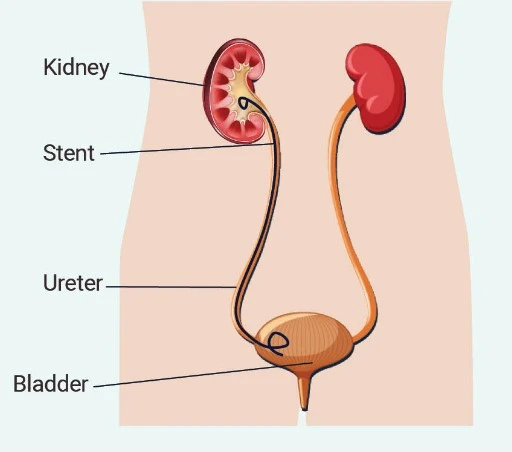 how to sleep with kidney stent