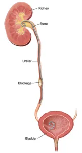 kidney stent