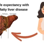 life expectancy with fatty liver disease